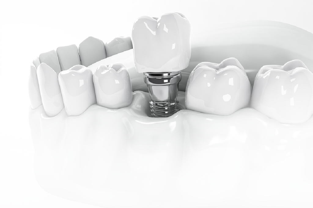 RESP SERVICIOS – IMPLANTES DENTALES