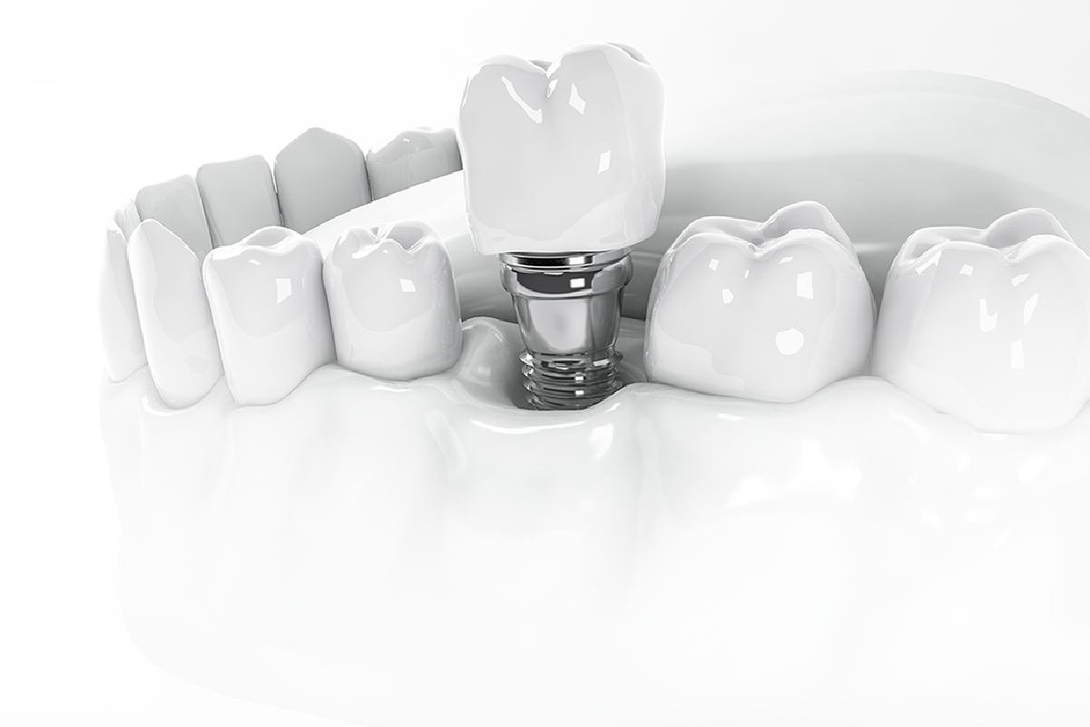 RESP SERVICIOS – IMPLANTES DENTALES