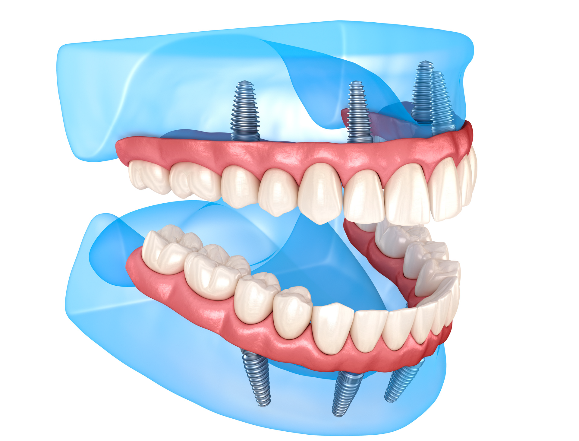 implantologia-carga-inmediata-dientes-en-un-dia-wedent.jpg